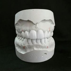 diagnostic_wax_ups_feb