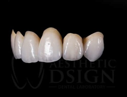 Tips for Selecting Tooth Shades
