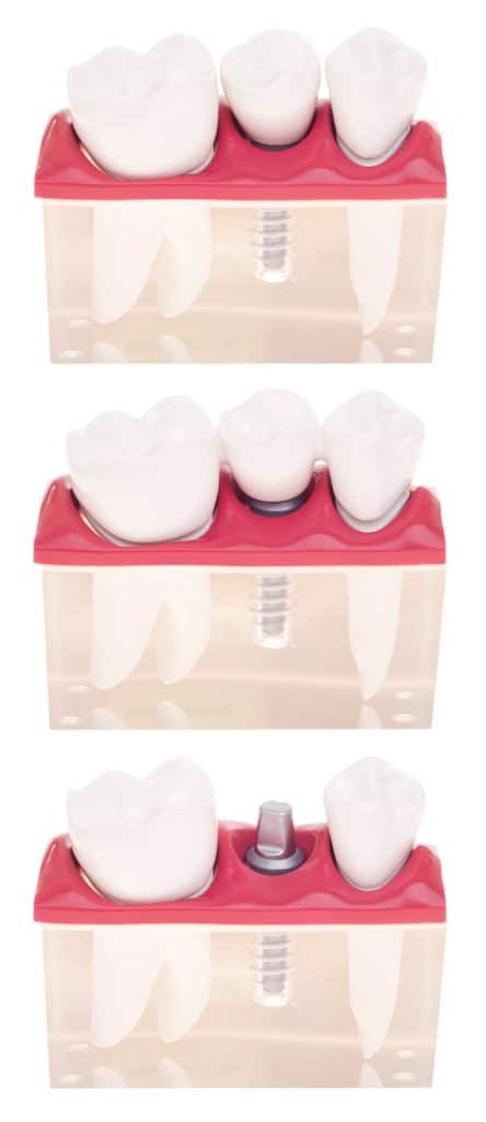 Implant dental model